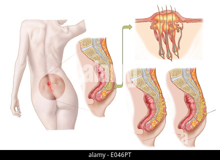 Medical illustrazione di una cisti pilonidal vicino a Natal schisi dei glutei. Foto Stock