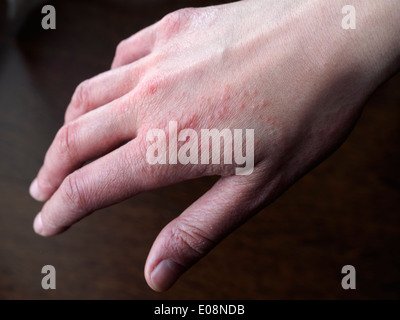 Mano con eczema Foto Stock