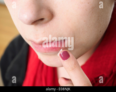 Giovane donna mettendo unguento sul labbro con herpes simplex Foto Stock