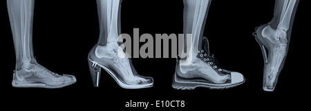 X-ray di piede di una donna in 4 diverse tipologie di calzature (da sinistra a destra) formatori, tacco alto, acceso e Balletto Foto Stock