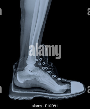 Raggi X di un piede e caviglia in una scarpa da running Foto Stock