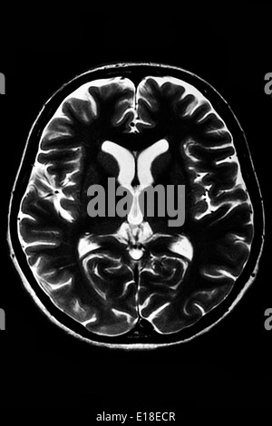 Sezione orizzontale di un cervello umano - MRI scan Foto Stock