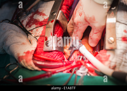 In bipolare sul lato sinistro del blocco di fibrillazione atriale valvola mitrale intervento di riparazione Foto Stock