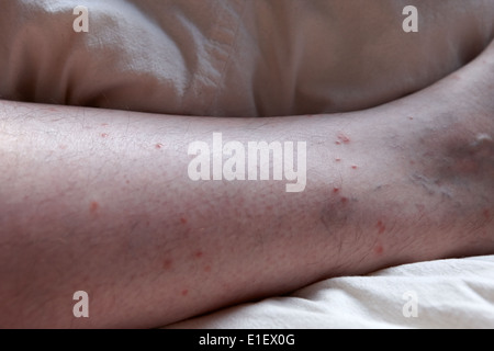 Persone di mezza età mans gamba con pulci e morsi di insetto marchi calza sopra la linea Foto Stock