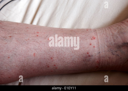 Persone di mezza età mans gamba con pulci e morsi di insetto marchi calza sopra la linea Foto Stock