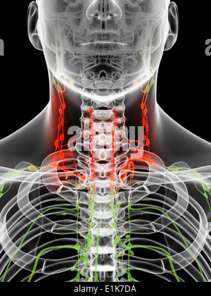 Infiammato nei linfonodi nel collo della computer grafica. Foto Stock