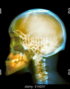 Cranio colorato X-ray del cranio di un trentennale maschio. Foto Stock