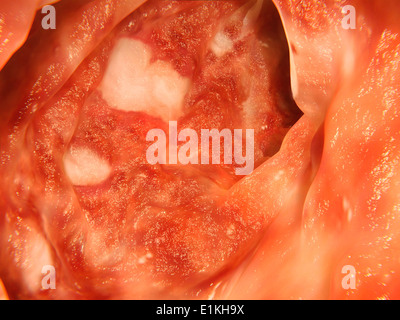 Opera sulla base di un'immagine endoscopica del colon affetti da colite ulcerosa. Foto Stock