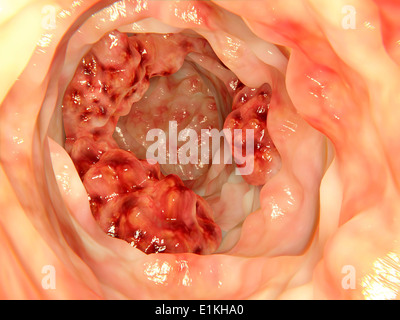Opera sulla base di un'immagine endoscopica di cancro al colon. Foto Stock