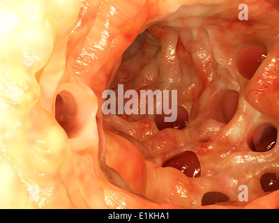 Opera sulla base di un'immagine endoscopica dei diverticoli nel colon. Foto Stock