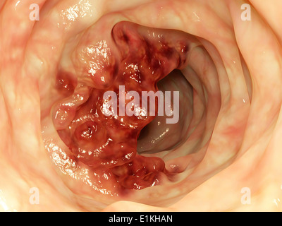 Opera sulla base di un'immagine endoscopica di un tumore al colon. Foto Stock