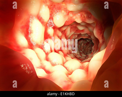 Opera sulla base di un'immagine endoscopica dell'intestino colpite da morbo di Crohn. Foto Stock