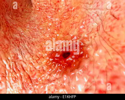 Opera sulla base di un'immagine endoscopica di ulcera di stomaco. Foto Stock