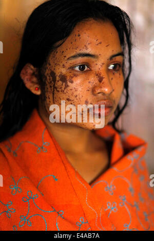 Kustia, Bangladesh. 7 Luglio, 2014. Un 18-anno-vecchia ragazza Sonia Akter una giovane donna con un acido bruciato-faccia è a Dhaka Medical in ospedale per il trattamento. Lancio di acido è un problema comune in Bangladesh. E circa, 300 persone sono state attaccate annuale nel quale il 41% delle vittime sono al di sotto dei 18 anni di età e il 78% delle vittime sono donne. Credito: zakir hossain chowdhury zakir/Alamy Live News Foto Stock