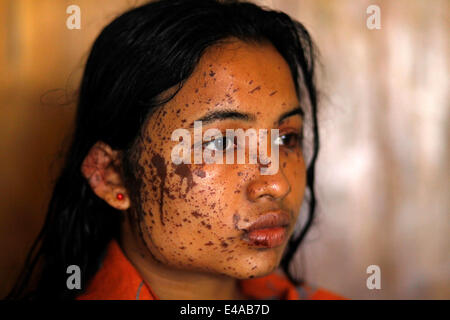 Kustia, Bangladesh. 7 Luglio, 2014. Un 18-anno-vecchia ragazza Sonia Akter con un acido bruciato-faccia è a Dhaka Medical in ospedale per il trattamento. Lancio di acido è un problema comune in Bangladesh. E circa, 300 persone sono state attaccate annuale nel quale il 41% delle vittime sono al di sotto dei 18 anni di età e il 78% delle vittime sono donne Credito: zakir hossain chowdhury/Alamy Live News Foto Stock