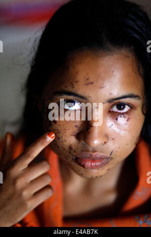 Kustia, Bangladesh. 7 Luglio, 2014. Un 18-anno-vecchia ragazza Sonia Akter soffre di attacchi di acido generata durante il sonno in kustia,Bangladesh ed ha ammesso DMCH. Lancio di acido è un problema comune in Bangladesh. Circa 300 persone attaccare ogni anno in Bangladesh. Il 41 per cento delle vittime sono sotto l'età di 18. Per la maggior parte delle vittime sono 10-30 gruppi di età. 78 acido di percento gettando sta accadendo con le donne. Credito: zakir hossain chowdhury zakir/Alamy Live News Foto Stock