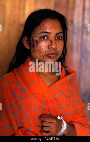 Kustia, Bangladesh. 7 Luglio, 2014. Un 18-anno-vecchia ragazza Sonia Akter soffre di attacchi di acido generata durante il sonno in kustia,Bangladesh ed ha ammesso DMCH. Lancio di acido è un problema comune in Bangladesh. Circa 300 persone attaccare ogni anno in Bangladesh. Il 41 per cento delle vittime sono sotto l'età di 18. Per la maggior parte delle vittime sono 10-30 gruppi di età. 78 acido di percento gettando sta accadendo con le donne. Credito: zakir hossain chowdhury zakir/Alamy Live News Foto Stock