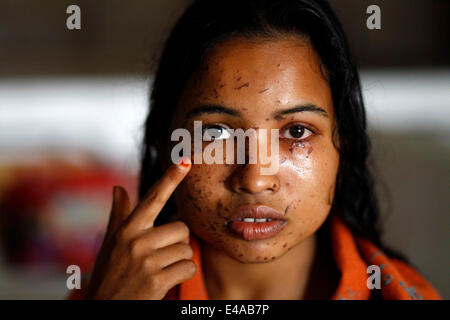 Kustia, Bangladesh. 7 Luglio, 2014. Un 18-anno-vecchia ragazza Sonia Akter soffre di attacchi di acido generata durante il sonno in kustia,Bangladesh ed ha ammesso DMCH. Lancio di acido è un problema comune in Bangladesh. Circa 300 persone attaccare ogni anno in Bangladesh. Il 41 per cento delle vittime sono sotto l'età di 18. Per la maggior parte delle vittime sono 10-30 gruppi di età. 78 acido di percento gettando sta accadendo con le donne. Credito: zakir hossain chowdhury zakir/Alamy Live News Foto Stock