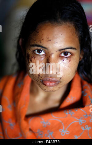 Kustia, Bangladesh. 7 Luglio, 2014. Un 18-anno-vecchia ragazza Sonia Akter soffre di attacchi di acido generata durante il sonno in kustia,Bangladesh ed ha ammesso DMCH. Lancio di acido è un problema comune in Bangladesh. Circa 300 persone attaccare ogni anno in Bangladesh. Il 41 per cento delle vittime sono sotto l'età di 18. Per la maggior parte delle vittime sono 10-30 gruppi di età. 78 acido di percento gettando sta accadendo con le donne. Credito: zakir hossain chowdhury zakir/Alamy Live News Foto Stock