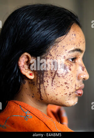 Kustia, Bangladesh. 7 Luglio, 2014. Un 18-anno-vecchia ragazza Sonia Akter soffre di attacchi di acido generata durante il sonno in kustia,Bangladesh ed ha ammesso DMCH. Lancio di acido è un problema comune in Bangladesh. Circa 300 persone attaccare ogni anno in Bangladesh. Il 41 per cento delle vittime sono sotto l'età di 18. Per la maggior parte delle vittime sono 10-30 gruppi di età. 78 acido di percento gettando sta accadendo con le donne. Credito: zakir hossain chowdhury zakir/Alamy Live News Foto Stock