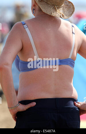 Sun Red bruciato la schiena di una donna matura in un reggiseno malva e cappello di paglia, di fronte al mare a Weston super Mare, Giugno 2014 Foto Stock