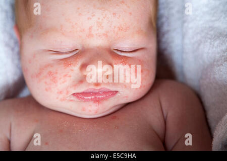 Due settimane vecchio con - probabilmente - baby neonatale acne o ' eritema Toxicum Neonatorum ' ETN; arriva presto dopo la nascita in molti casi Foto Stock