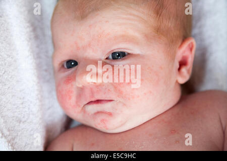 Due settimane vecchio con - probabilmente - baby neonatale acne o ' eritema Toxicum Neonatorum ' ETN; arriva presto dopo la nascita in molti casi Foto Stock