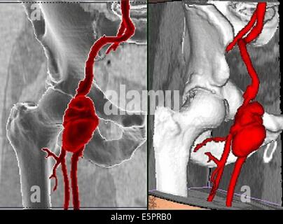 Tridimensionale di tomografica computerizzata (CT) la ricostruzione della scansione di arteria femorale destra aneurisma infettivo, appare come Foto Stock