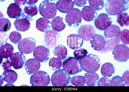 La fotomicrografia di cellule del sangue infetto da virus di Epstein-Barr (EBV), un herpes virus responsabili di malattie infettive Foto Stock