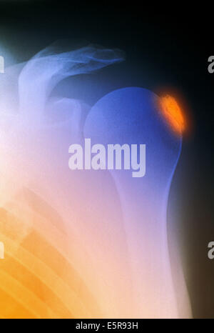 Colore esaltato X-ray di spalla con calcific tendinite. Foto Stock