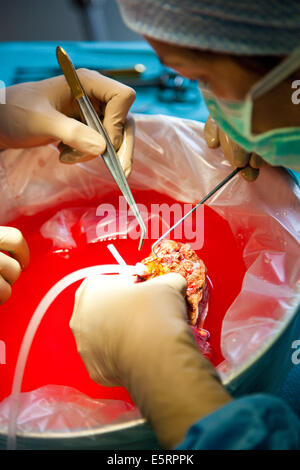 Rimozione parziale di un fegato da un donatore vivente per laparoscopia per un trapianto, qui, preparazione di innesto, Dipartimento di Foto Stock