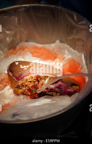 Rimozione parziale di un fegato da un donatore vivente per laparoscopia per un trapianto, qui, preparazione di innesto, Dipartimento di Foto Stock