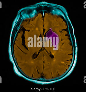 Colorato di risonanza magnetica (RM) e scansione CT di una sezione assiale attraverso il cervello del paziente, che mostra i danni Foto Stock