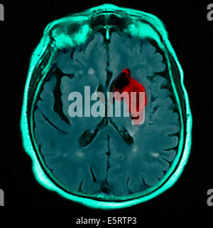 Colorato di risonanza magnetica (RM) e scansione CT di una sezione assiale attraverso il cervello del paziente, che mostra i danni Foto Stock