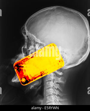 Colorato X-ray che mostra la testa di un uomo utilizzando uno smartphone. L'uso del telefono cellulare genera microonde che penetrano nel Foto Stock