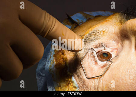 Aspetto dell'occhio dopo la rimozione della cornea del bulbo oculare con conservazione e iride che conserva il suo colore, Angoulême Foto Stock