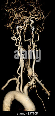 Arteria vertebrale aneurisma (in basso a destra) 3D CT-angiografia. Foto Stock