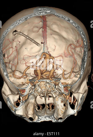 3D tomografica computerizzata (CT) scansione la ricostruzione di un cranio che mostra un aneurisma intracranica (sagomato gonfiore) situato nel Foto Stock