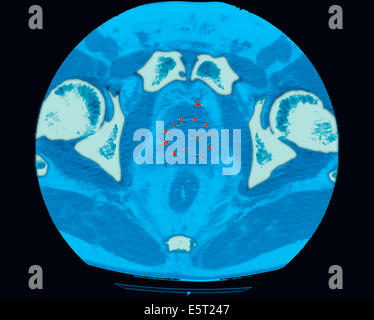 Tomografia computerizzata (CT) scansione sorgenti radioattive (punti rossi) che sono state inserite in una ghiandola della prostata per trattare il cancro, Foto Stock