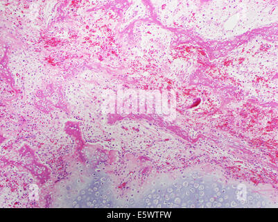 H&E macchia, la microscopia ottica, guarigione callo di frattura di esuberante di cartilagine e la formazione di osso nuovo Foto Stock