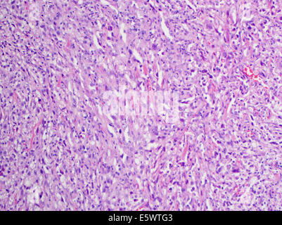 H&E macchia, la microscopia ottica, il melanoma maligno della pelle Foto Stock