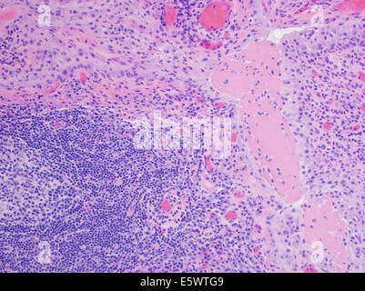 H&E macchia, la microscopia ottica, artrite reumatoide di joint mostra pannus Foto Stock