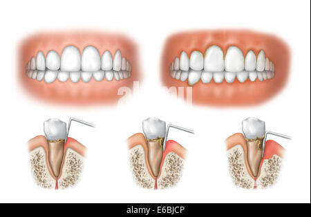Tre stadi di malattia periodontale. Foto Stock