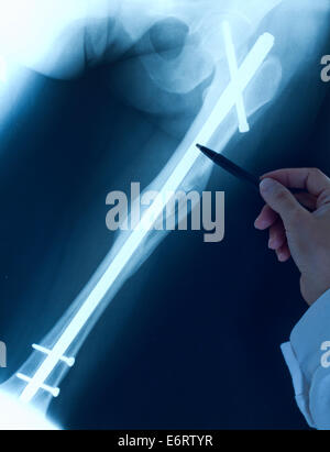 Medico ortopedico esaminare x-ray con gamba rotta dopo la chirurgia Foto Stock