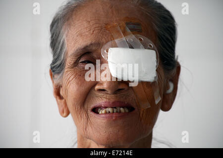 Yangon, Myanmar. 4 Sep, 2014. Un paziente indossa un occhio patch dopo la chirurgia di Yangon, Myanmar, Sett. 4, 2014. Un Cinese team medico ha iniziato un occhio libero il trattamento chirurgico campagna in Yangon giovedì come la terza di questo genere di 'Luminosità' azione nel paese. Credito: U Aung/Xinhua/Alamy Live News Foto Stock