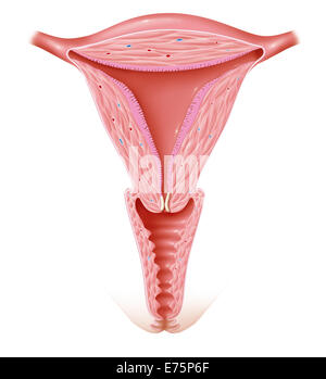 Il cancro cervicale, disegno Foto Stock