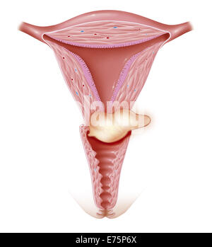 Il cancro cervicale, disegno Foto Stock