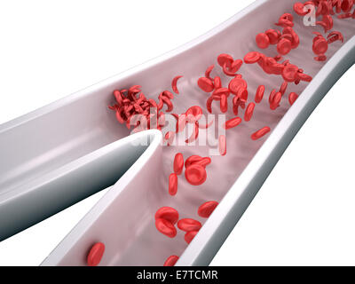 Cellule falciformi bloccando il flusso di sangue - isolato su bianco Foto Stock