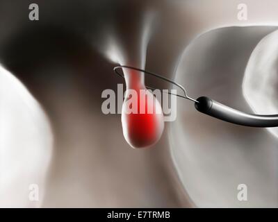 La rimozione di un polipo nel colon umano, computer grafica. Foto Stock