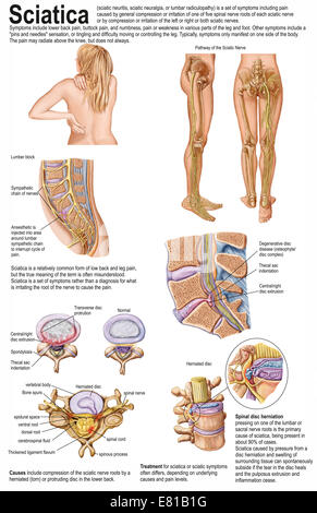 Diagramma di medici che mostra i segni e i sintomi della sciatica. Foto Stock